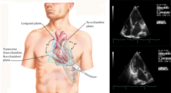 ECG