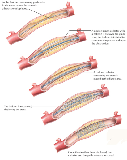 percutaneous coronary